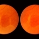 Retinoschisis Retinoschisis