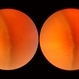 Retinoschisis Retinoschisis