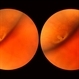 Asymptomatic Lesion Asymptomatic Lesion