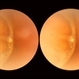 Yellow Globular Lesion Yellow Globular Lesion