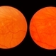 Scleral Indentation Scleral Indentation