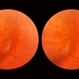 Scleral Indentation Scleral Indentation