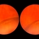 Elevated Lesion Elevated Lesion
