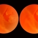 Acute Posterior Vitreous Detachment Acute Posterior Vitreous Detachment