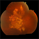 Serpiginous Serpiginous