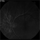 Serpiginous Serpiginous