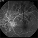 Serpiginous Serpiginous