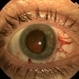 Ciliary Body Melanoma With Partial Ring Configuration and Diffuse Sentinel Vessels