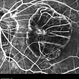 Degenerative Myopia Degenerative Myopia