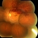 Branch Retinal Vein Occlusion Branch Retinal Vein Occlusion