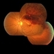 Branch Retinal Vein Occlusion Branch Retinal Vein Occlusion