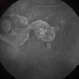Myopic Degeneration - Fluorescein Angiography Myopic Degeneration - Fluorescein Angiography