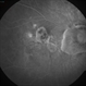 Myopic Degeneration - Fluorescein Angiography Myopic Degeneration - Fluorescein Angiography