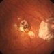 Myopic Degeneration - Fundus Image Myopic Degeneration - Fundus Image