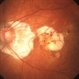 Myopic Degeneration - Fundus Image Myopic Degeneration - Fundus Image