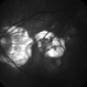 Myopic Degeneration - Red Free Myopic Degeneration - Red Free