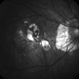 Myopic degeneration - Red-Free Myopic degeneration - Red-Free