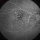 Myopic Degeneration - Fluorescein Angiography Myopic Degeneration - Fluorescein Angiography
