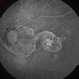 Myopic Degeneration - Fluorescein Angiography Myopic Degeneration - Fluorescein Angiography