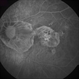 Myopic Degeneration - Fluorescein Angiography Myopic Degeneration - Fluorescein Angiography