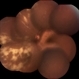 Chorioretinal Fold Chorioretinal Fold