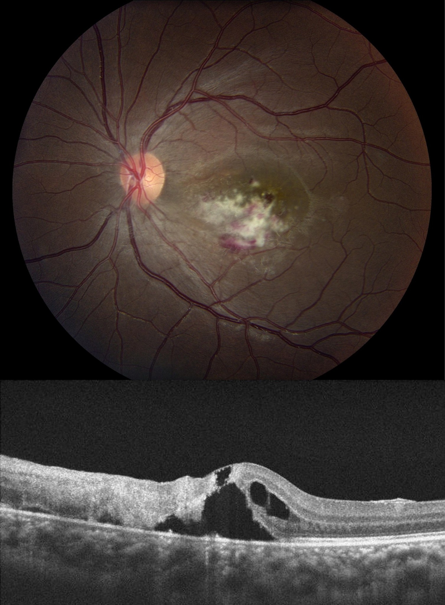 normal retina vs cmv retinitis normal retina vs cmv retinitis