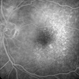 Choroidal Neovascularization with Retinal Angiomatous Proliferation