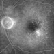 Choroidal Neovascularization with Retinal Angiomatous Proliferation