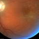 Choroidal Neovascularization with Retinal Angiomatous Proliferation