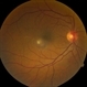 Endophthalmitis Endophthalmitis