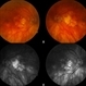 AMD - Geographic Atrophy