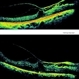Macular Traction in PDR Macular Traction in PDR