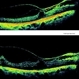 Macular Traction in  PDR Macular Traction in  PDR