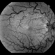 Central Retinal Vein Occlusion Central Retinal Vein Occlusion