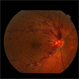 Central Retinal Vein Occlusion: Case 1 Central Retinal Vein Occlusion: Case 1