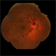 Central Retinal Vein Occlusion: Case 1 Central Retinal Vein Occlusion: Case 1