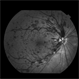 Central Retinal Vein Occlusion: Case 1 Central Retinal Vein Occlusion: Case 1
