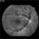 Central Retinal Vein Occlusion: Case 1 Central Retinal Vein Occlusion: Case 1