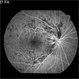 Central Retinal Vein Occlusion: Case 1 Central Retinal Vein Occlusion: Case 1