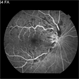 Central Retinal Vein Occlusion: Case 1 Central Retinal Vein Occlusion: Case 1
