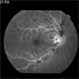 Central Retinal Vein Occlusion: Case 1 Central Retinal Vein Occlusion: Case 1