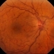 Central Retinal Vein Occlusion - After 3 Consecutive Ranibizumab Injections