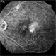CRVO with Choroidal Profusion Delay CRVO with Choroidal Profusion Delay