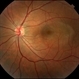 Neurosensory Detachment with associated Pigment Epithelial Detachment