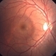 Central Serous Chorioretinopathy Central Serous Chorioretinopathy