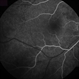 Central Serous Chorioretinopathy Central Serous Chorioretinopathy