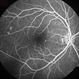 Central Serous Chorioretinopathy, Fluorescein Angiogram Central Serous Chorioretinopathy, Fluorescein Angiogram