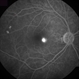 Central Serous Chorioretinopathy, Fluorescein Angiogram Central Serous Chorioretinopathy, Fluorescein Angiogram