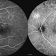 Chronic Active Central Serous Chorioretinopathy (CSCR) Chronic Active Central Serous Chorioretinopathy (CSCR)