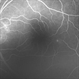 Central Serous Chorioretinopathy Smokestack 1 Central Serous Chorioretinopathy Smokestack 1